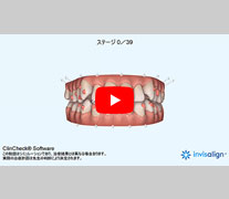歯の移動シミュレーション